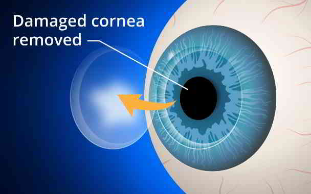 what are common corneal disorders in kannada
